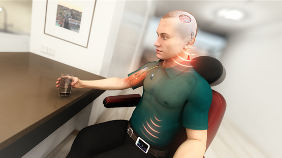 Figure 1. The Wyss Center’s vision for the future of the BCI to FES systems. The Center is working on a miniaturised, wireless and subcutaneous version of existing technologies that record movement intention from the brain and use it to activate muscles in a paralysed arm.